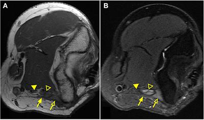 Characteristics of Patients With Complex Limb Pain Evaluated Through an Interdisciplinary Approach Utilizing Magnetic Resonance Neurography